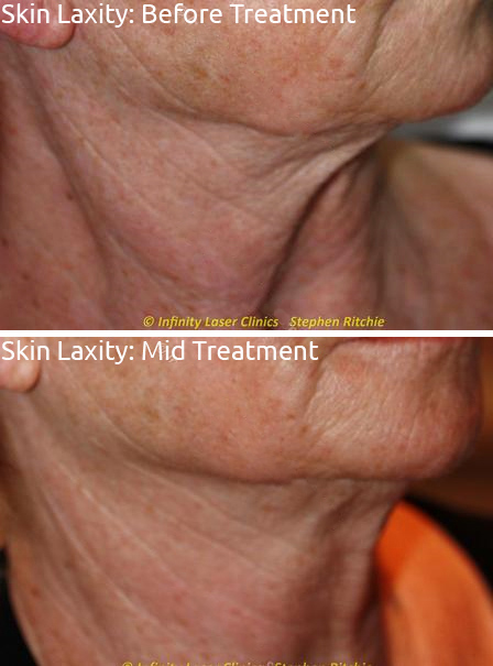 Combination Treatments Infinity Laser Clinics