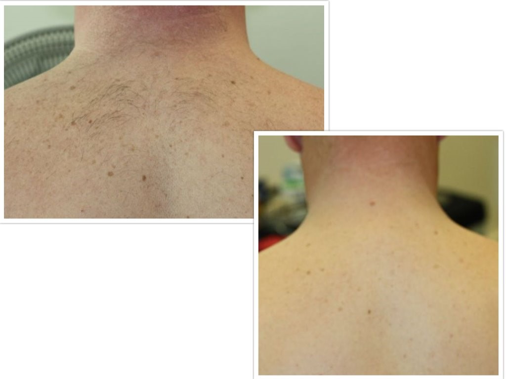 Hair Reduction2 (1)