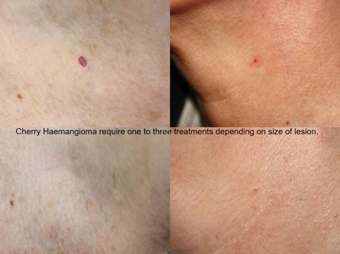 Infinity Laser Clinics Advance Laser Aesthetics Image Deeper Vascular 001